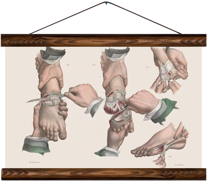 Foot surgery methods, reprint on linen - Josef und Josefine